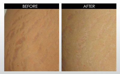 Stretchmarks: before and after